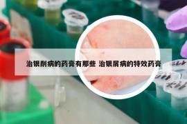 治銀削病的藥膏有那些 治銀屑病的特效藥膏