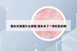 額頭長(zhǎng)癬是什么原因 額頭長(zhǎng)了一塊紅色的癬