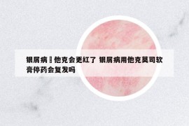 銀屑病凃他克會(huì)更紅了 銀屑病用他克莫司軟膏停藥會(huì)復(fù)發(fā)嗎