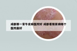 成都那一家牛皮癬醫(yī)院好 成都看銀屑病哪個醫(yī)院最好