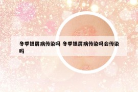 冬季銀屑病傳染嗎 冬季銀屑病傳染嗎會(huì)傳染嗎