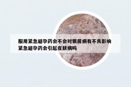 服用緊急避孕藥會不會對銀屑病有不良影響 緊急避孕藥會引起皮膚病嗎