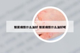 銀屑病擦什么油好 銀屑病擦什么油好呢