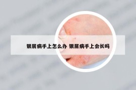銀屑病手上怎么辦 銀屑病手上會(huì)長(zhǎng)嗎
