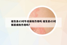 維生素d3對(duì)牛皮癬有作用嗎 維生素d3對(duì)銀屑病有作用嗎?