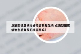 點滴型銀屑病治好后容易復發(fā)嗎 點滴型銀屑病治愈后復發(fā)的概率高嗎?