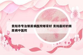 貴陽(yáng)市專(zhuān)治銀屑病醫(yī)院哪家好 貴陽(yáng)最好的銀屑病中醫(yī)院
