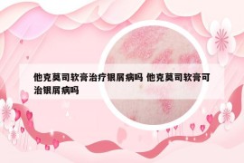 他克莫司軟膏治療銀屑病嗎 他克莫司軟膏可治銀屑病嗎