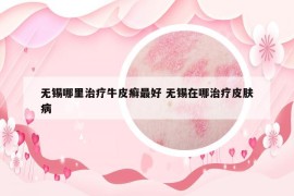 無錫哪里治療牛皮癬最好 無錫在哪治療皮膚病