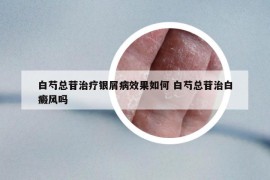 白芍總苷治療銀屑病效果如何 白芍總苷治白癜風(fēng)嗎
