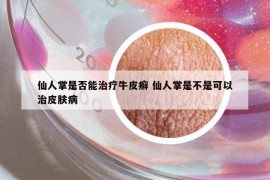仙人掌是否能治療牛皮癬 仙人掌是不是可以治皮膚病