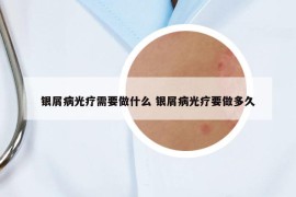 銀屑病光療需要做什么 銀屑病光療要做多久