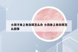 小孩子身上有白斑怎么辦 小孩身上有白斑怎么回事
