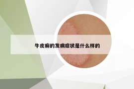 牛皮癬的發(fā)病癥狀是什么樣的