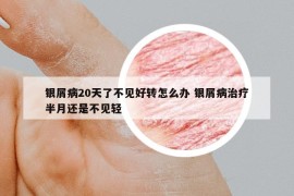 銀屑病20天了不見好轉(zhuǎn)怎么辦 銀屑病治療半月還是不見輕