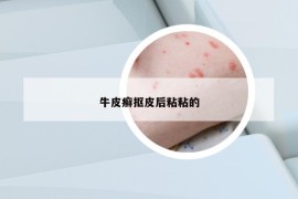 牛皮癬摳皮后粘粘的