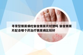 尋常型銀屑病吃郁金銀屑片好使嗎 郁金銀屑片配合哪個藥治療銀屑病比較好