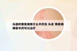 頭部的銀屑病用什么中藥洗 頭皮 銀屑病 哪些中藥可以治療