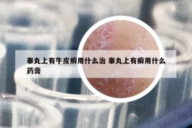 睪丸上有牛皮癬用什么治 睪丸上有癬用什么藥膏