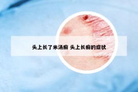 頭上長(zhǎng)了米湯癬 頭上長(zhǎng)癬的癥狀