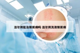 潔爾陰能治銀屑病嗎 潔爾陰洗液銀屑病