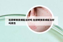 肚臍眼銀屑病能治好嗎 肚臍眼銀屑病能治好嗎男性