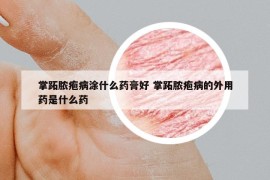掌跖膿皰病涂什么藥膏好 掌跖膿皰病的外用藥是什么藥
