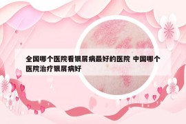 全國哪個醫(yī)院看銀屑病最好的醫(yī)院 中國哪個醫(yī)院治療銀屑病好