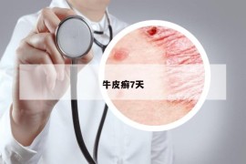 牛皮癬7天