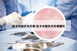 肚子大腿長大片癬 肚子大腿長大片癬圖片