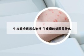 牛皮廨應(yīng)該怎么治療 牛皮廨的病因是什么