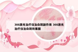 308激光治療儀治白斑副作用 308激光治療儀治白斑效果圖