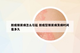 膿皰銀屑病怎么引起 膿皰型銀屑病發(fā)病時(shí)間是多久