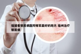 福建看銀屑病醫(yī)院哪家最好的地方 福州治療銀屑病