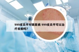 999皮炎平對(duì)銀屑病 999皮炎平可以治療皮癬嗎?