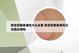 膿包型銀屑病吃什么水果 膿包型銀屑病可以吃西紅柿嗎