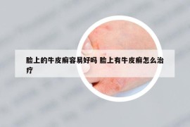 臉上的牛皮癬容易好嗎 臉上有牛皮癬怎么治療