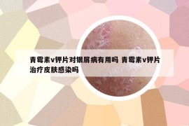 青霉素v鉀片對銀屑病有用嗎 青霉素v鉀片治療皮膚感染嗎