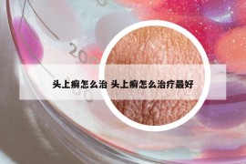 頭上癬怎么治 頭上癬怎么治療最好