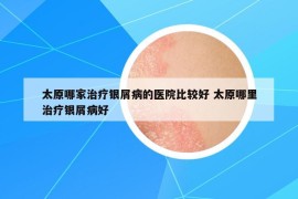 太原哪家治療銀屑病的醫(yī)院比較好 太原哪里治療銀屑病好