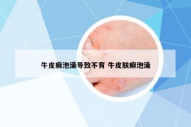 牛皮癬泡澡導(dǎo)致不育 牛皮膚癬泡澡