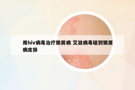 用hiv病毒治療銀屑病 艾滋病毒碰到銀屑病皮損
