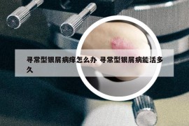 尋常型銀屑病癢怎么辦 尋常型銀屑病能活多久