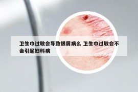衛(wèi)生巾過敏會導致銀屑病么 衛(wèi)生巾過敏會不會引起婦科病