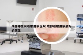 成都那里有看銀屑病醫(yī)院 成都看銀屑病最好的醫(yī)生