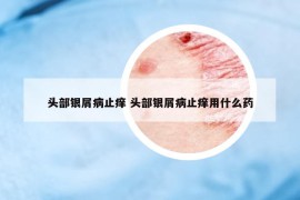 頭部銀屑病止癢 頭部銀屑病止癢用什么藥