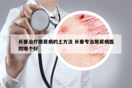 長春治療銀屑病的土方法 長春專治銀屑病醫(yī)院哪個(gè)好