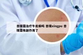 杏璞霜治療牛皮癬嗎 杏璞xingpu 杏璞霜有副作用了