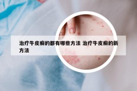 治療牛皮癬的都有哪些方法 治療牛皮癬的新方法