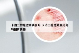 卡泊三醇是激素藥膏嗎 卡泊三醇是激素藥膏嗎圖片價格